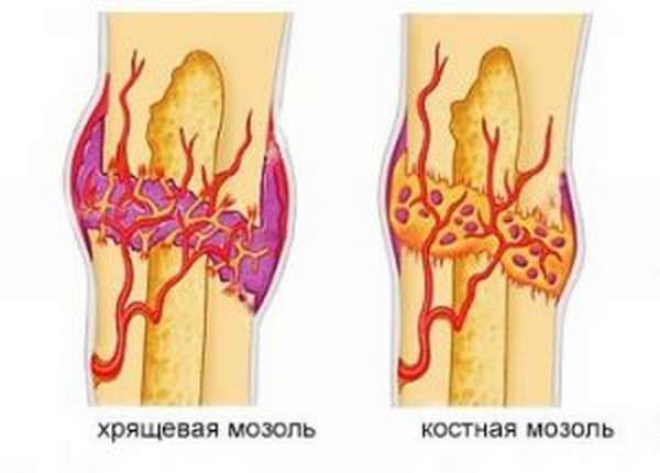 Симптомы и лечение перелома локтевой кости